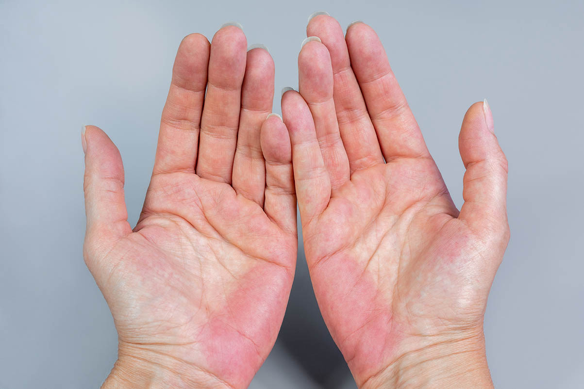 Erythème palmaire (EP) bilatéral. Paume des mains rouges.